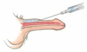 Hyaluronsäure Injektiounen